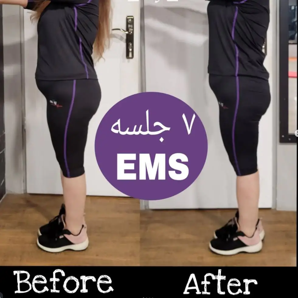 قبل و بعد شکم با ورزش EMS